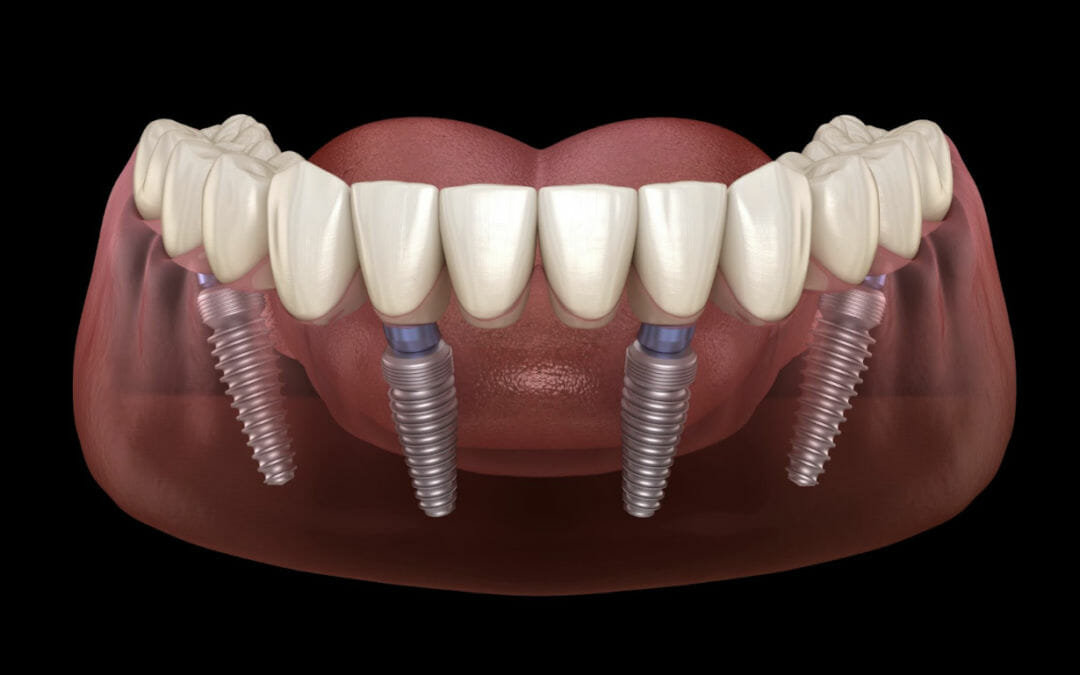All-on-4 Dental Implants Can Help You Regain Your Smile!