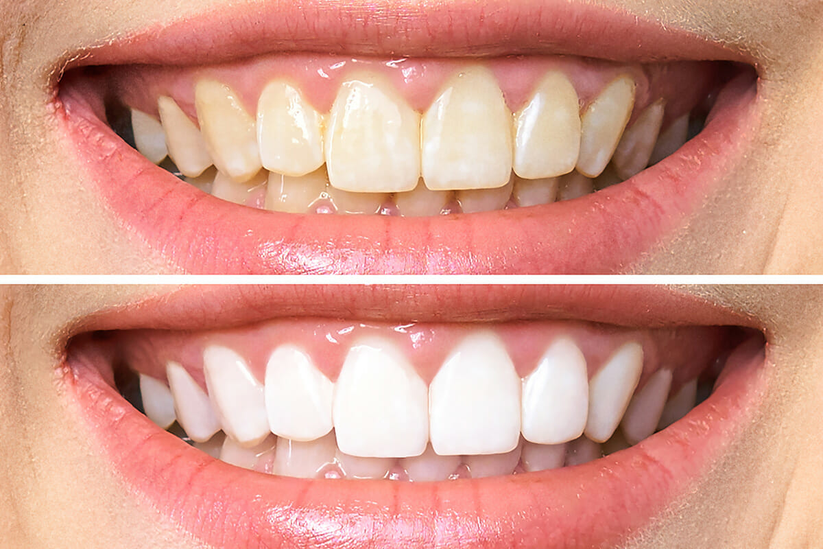 Teeth Whitening for Whiter, Brighter Teeth | Eastgate Dental