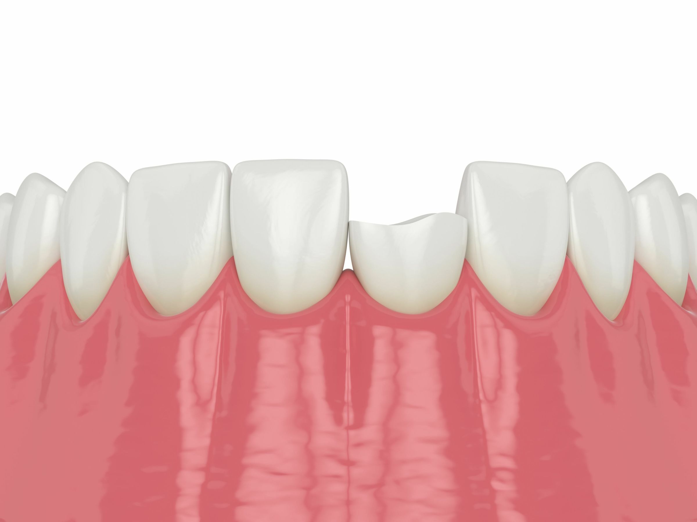 5-solutions-for-fixing-a-chipped-or-broken-tooth-smile-restoration