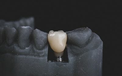 What Are Dental Crowns, Types of Crowns, & How to Restore Them