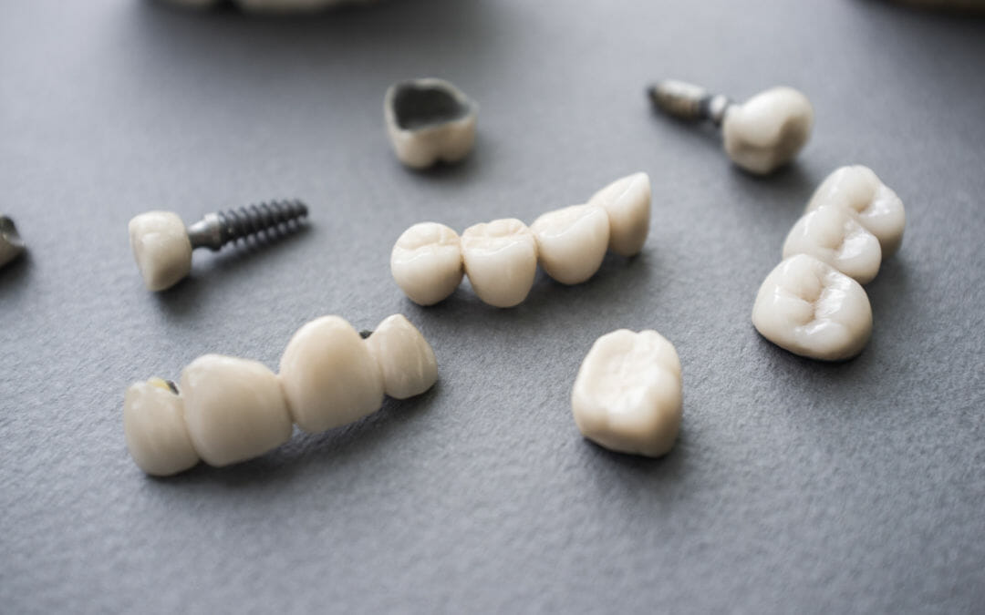 What Is The Process Of Implant Restoration